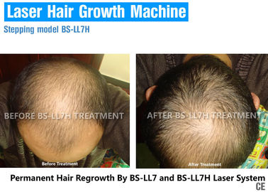 Безболезненный прибор Регровтх волос лазера диода с терапией подмолаживания волос для выпадения волос